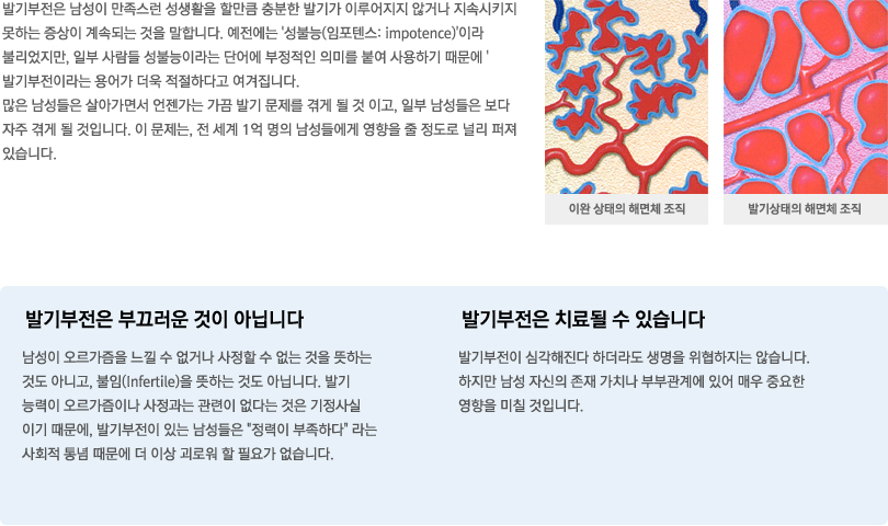 발기부전이란